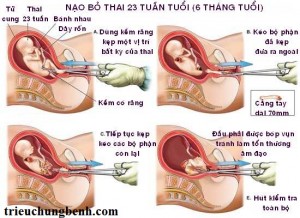 nạo phá thai