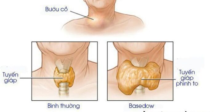 Hình ảnh tuyến giáp