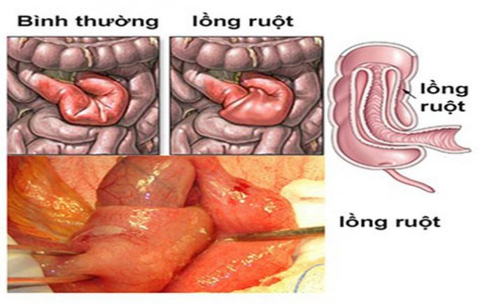 Lồng ruột ở trẻ