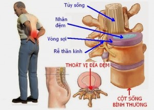 Cách điều trị thoát vị đĩa đệm 