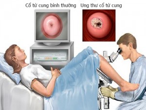 Soi cổ tử cung