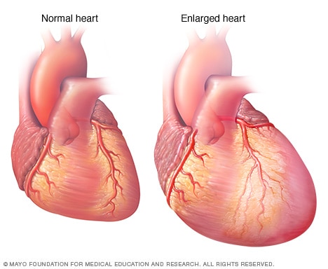 Enlarged heart, in heart failure - Mayo Clinic