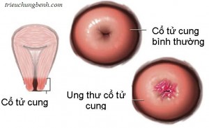 Hình ảnh ung thư cổ tử cung