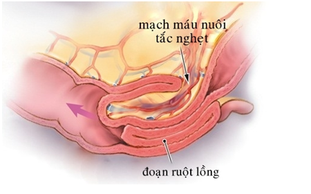 LỒNG RUỘT - khi bạn có kiến thức, con trẻ có thể thoát khỏi nguy ...