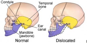  rối loạn khớp thái dương hàm.