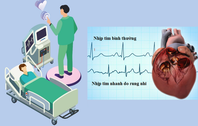 Triệu chứng tim đập nhanh là bệnh gì và cách giảm nhịp tim | Báo ...