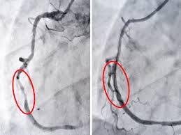 Hình ảnh động mạch vành sau khi được tái tưới máu